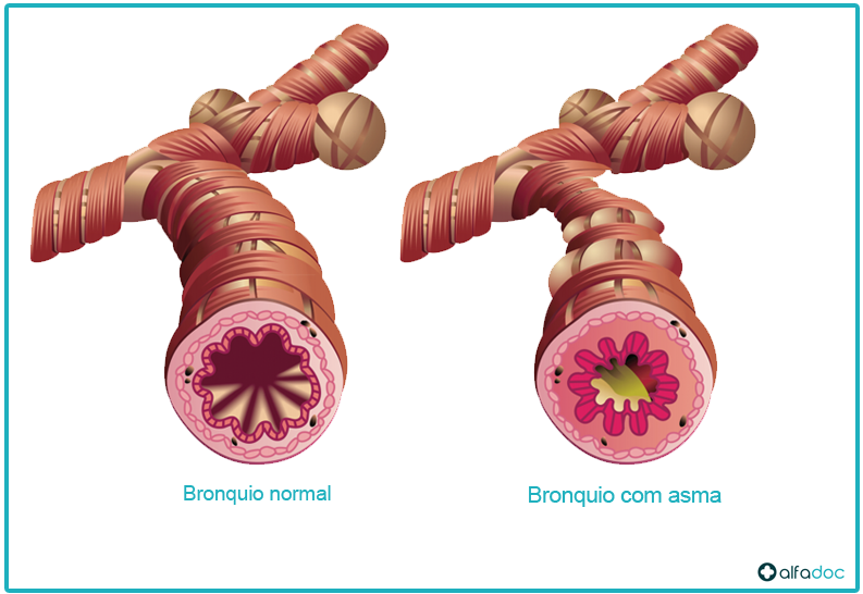 Bronquio-com-asma